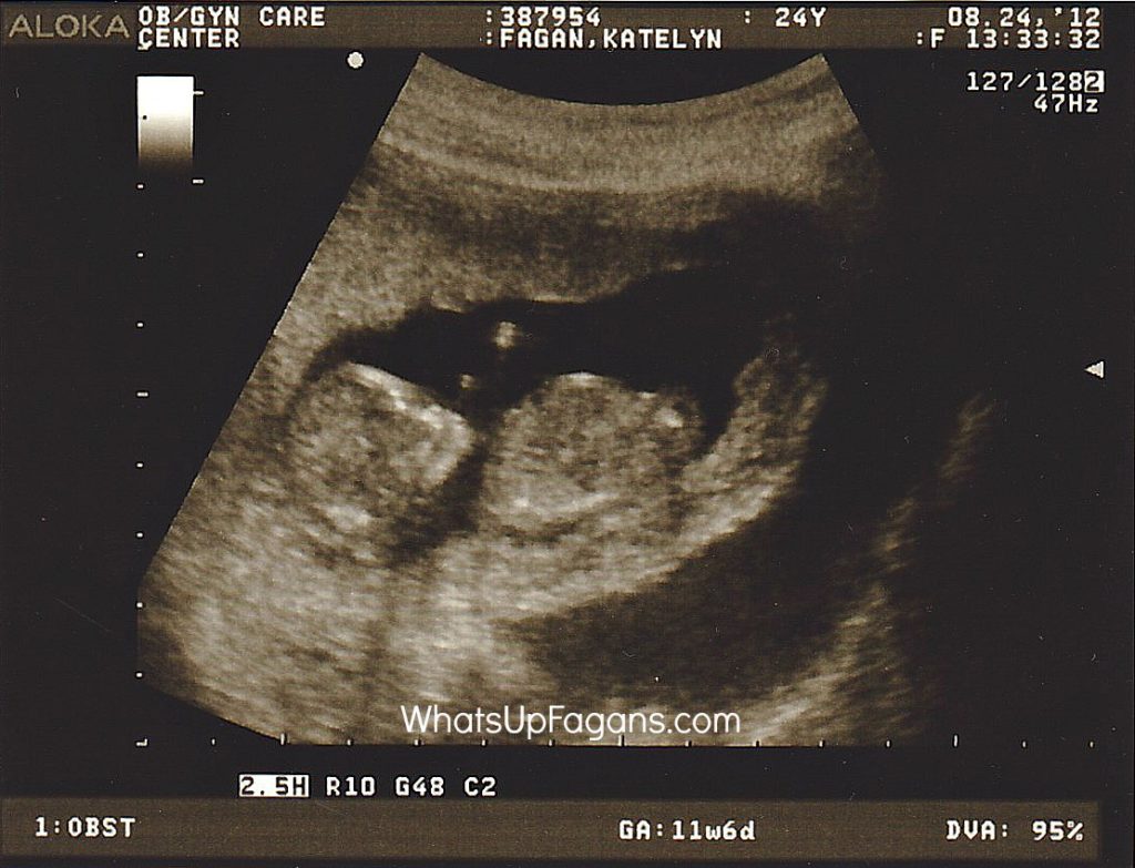 first-pregnancy-sonogram-ultrasound