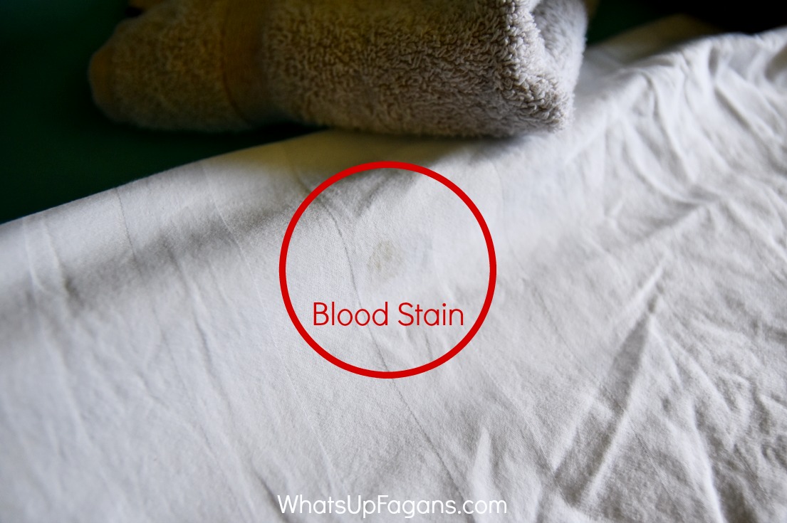 How To Remove Dried Set In Blood Stains From Clothes,What Is A Fat Quarter Bundle